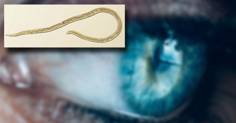 Oben links ist ein solcher Augenwurm zu sehen. Foto (oben links): Centers for Disease Control and Prevention/dpa-Bildfunk