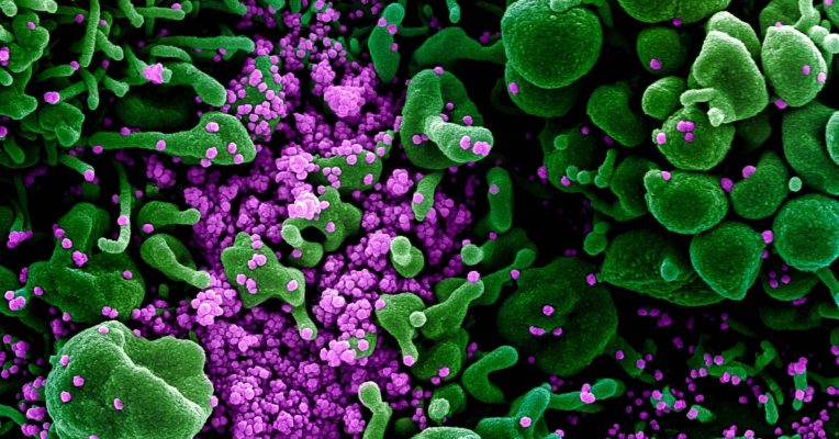 Die Zahl der Corona-Infektionen im Saarland ist gestiegen. Unser Foto aus einem Mikroskop zeigt eine mit dem Virus (lila) infizierte Zelle (grün).  Foto: Niaid/Europa Press/dpa-Bildfunk